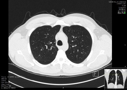 High-resolution computed tomograph of a normal thorax, axial plane (30)
