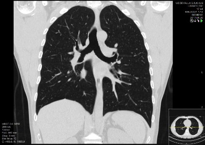 High-resolution computed tomograph of a normal thorax, coronal plane (36)