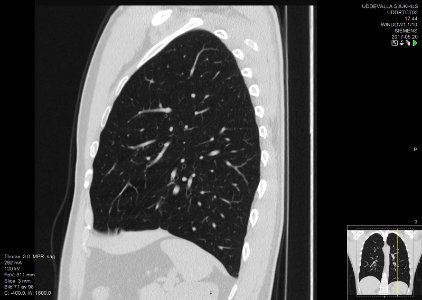High-resolution computed tomograph of a normal thorax, sagittal plane (71)