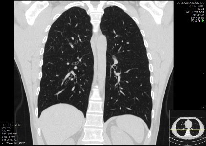 High-resolution computed tomograph of a normal thorax, coronal plane (42)