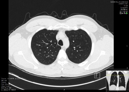 High-resolution computed tomograph of a normal thorax, axial plane (25)