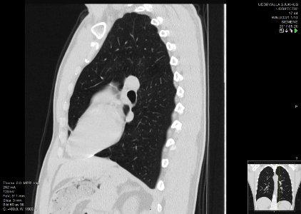 High-resolution computed tomograph of a normal thorax, sagittal plane (60)