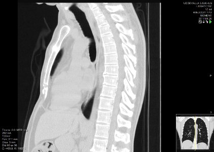 High-resolution computed tomograph of a normal thorax, sagittal plane (50)