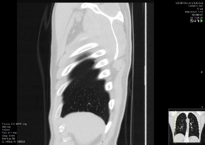 High-resolution computed tomograph of a normal thorax, sagittal plane (9)