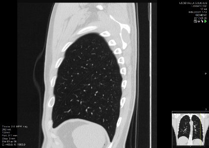 High-resolution computed tomograph of a normal thorax, sagittal plane (83)