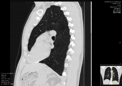 High-resolution computed tomograph of a normal thorax, sagittal plane (59)