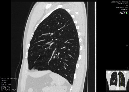 High-resolution computed tomograph of a normal thorax, sagittal plane (70)