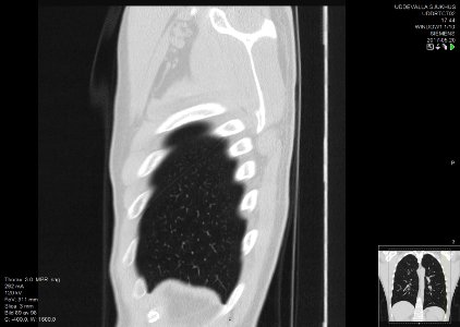 High-resolution computed tomograph of a normal thorax, sagittal plane (89)
