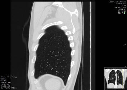 High-resolution computed tomograph of a normal thorax, sagittal plane (86)