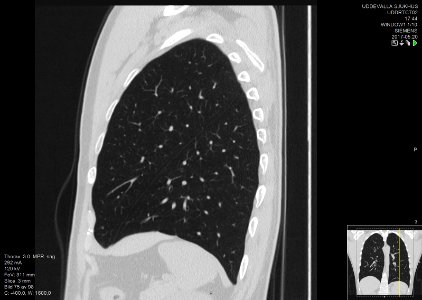 High-resolution computed tomograph of a normal thorax, sagittal plane (75)