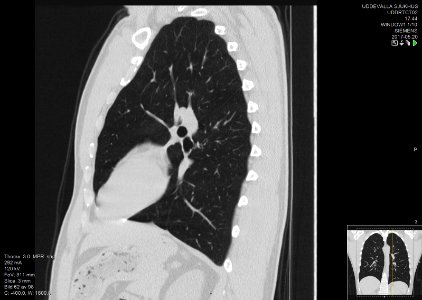 High-resolution computed tomograph of a normal thorax, sagittal plane (62)