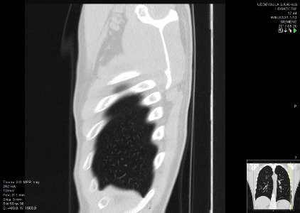 High-resolution computed tomograph of a normal thorax, sagittal plane (90)