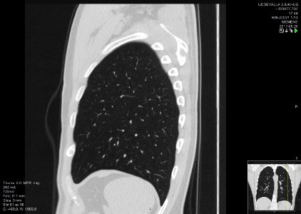 High-resolution computed tomograph of a normal thorax, sagittal plane (81)