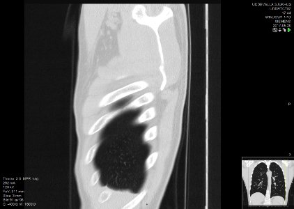 High-resolution computed tomograph of a normal thorax, sagittal plane (91)