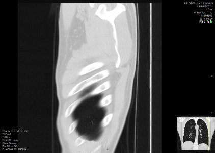 High-resolution computed tomograph of a normal thorax, sagittal plane (92)