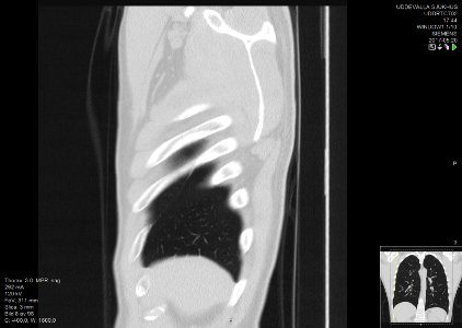 High-resolution computed tomograph of a normal thorax, sagittal plane (8)