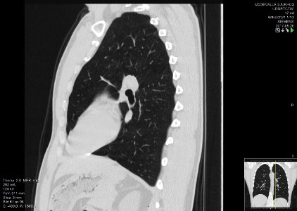 High-resolution computed tomograph of a normal thorax, sagittal plane (61)