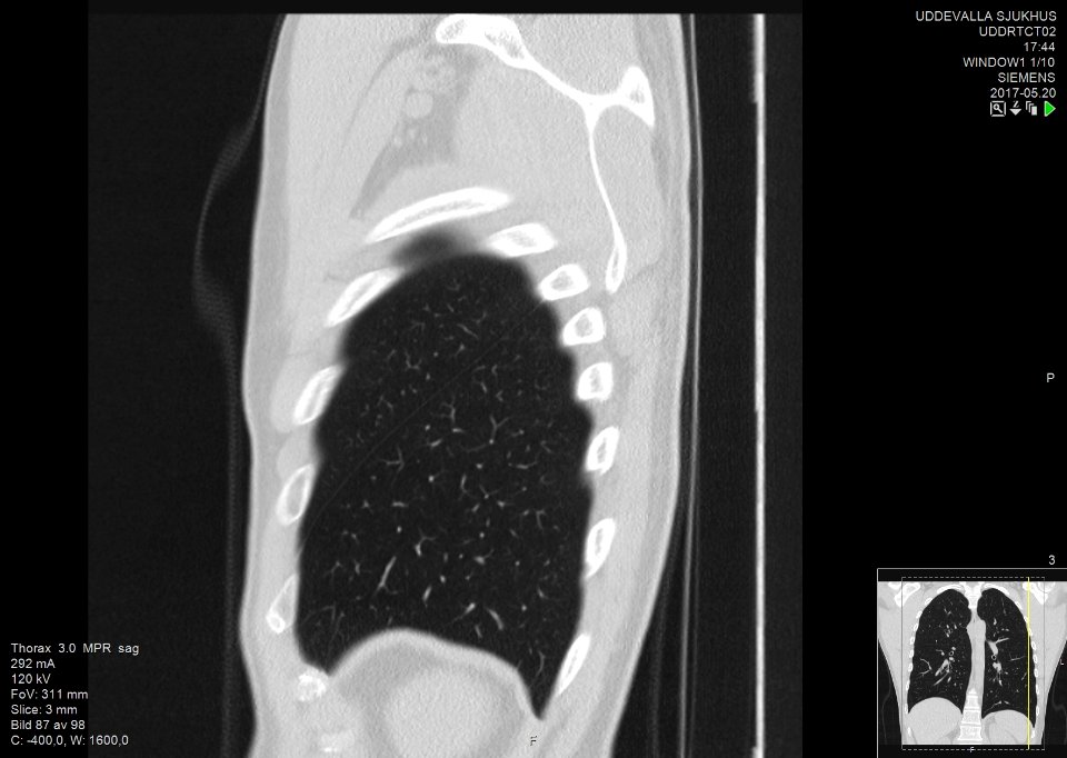 High-resolution computed tomograph of a normal thorax, sagittal plane (87)