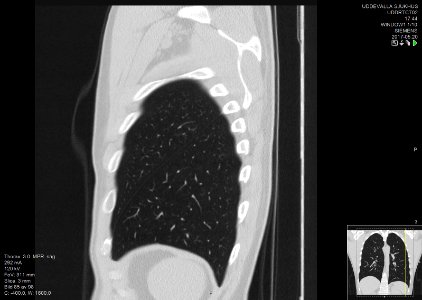 High-resolution computed tomograph of a normal thorax, sagittal plane (85)