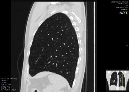 High-resolution computed tomograph of a normal thorax, sagittal plane (76)