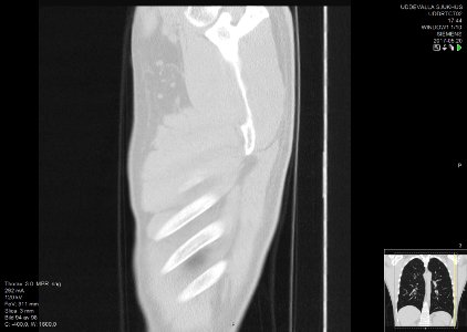 High-resolution computed tomograph of a normal thorax, sagittal plane (94)