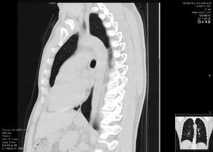 High-resolution computed tomograph of a normal thorax, sagittal plane (55)