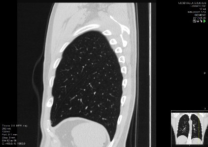 High-resolution computed tomograph of a normal thorax, sagittal plane (82)