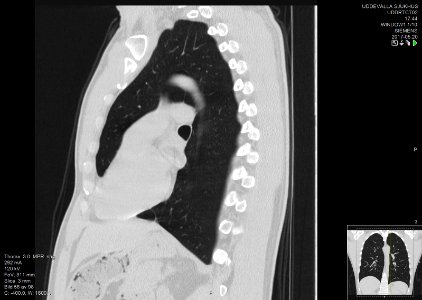 High-resolution computed tomograph of a normal thorax, sagittal plane (58)