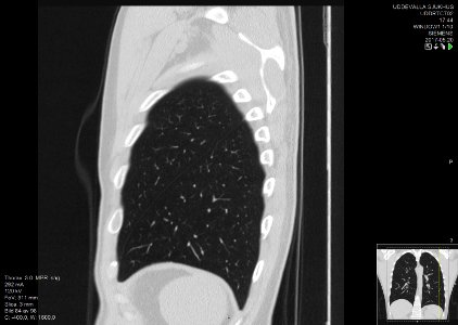 High-resolution computed tomograph of a normal thorax, sagittal plane (84)