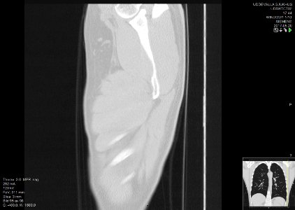 High-resolution computed tomograph of a normal thorax, sagittal plane (95)