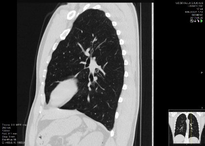 High-resolution computed tomograph of a normal thorax, sagittal plane (65)