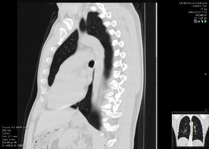 High-resolution computed tomograph of a normal thorax, sagittal plane (56)