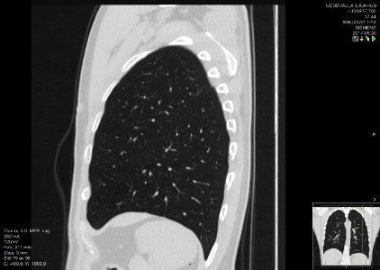 High-resolution computed tomograph of a normal thorax, sagittal plane (79)