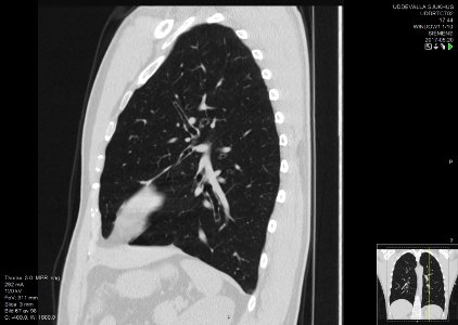 High-resolution computed tomograph of a normal thorax, sagittal plane (67)