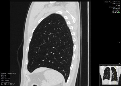 High-resolution computed tomograph of a normal thorax, sagittal plane (78)