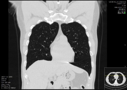 High-resolution computed tomograph of a normal thorax, coronal plane (16)