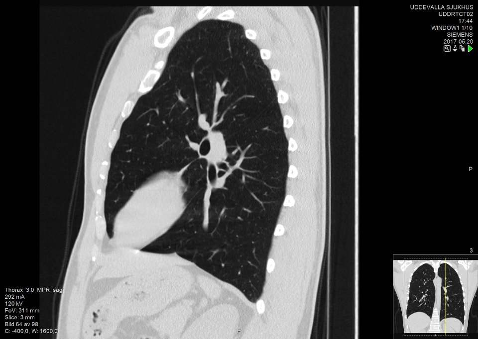 High-resolution computed tomograph of a normal thorax, sagittal plane (64)
