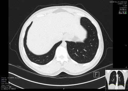 High-resolution computed tomograph of a normal thorax, axial plane (88)