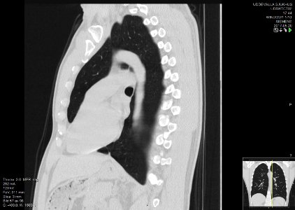 High-resolution computed tomograph of a normal thorax, sagittal plane (57)