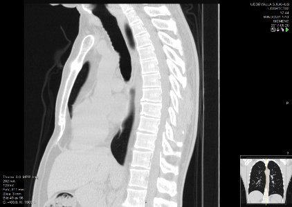 High-resolution computed tomograph of a normal thorax, sagittal plane (49)