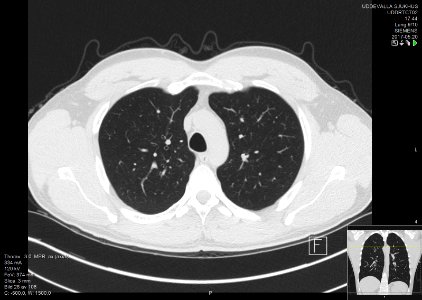 High-resolution computed tomograph of a normal thorax, axial plane (28)