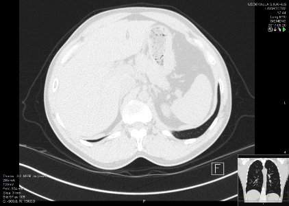 High-resolution computed tomograph of a normal thorax, axial plane (107)