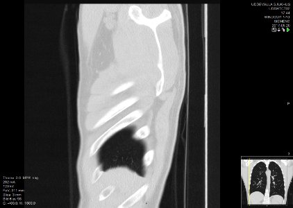 High-resolution computed tomograph of a normal thorax, sagittal plane (6)