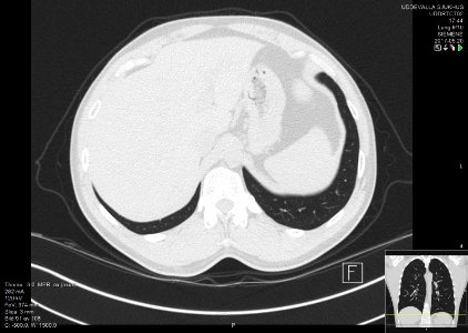 High-resolution computed tomograph of a normal thorax, axial plane (98)