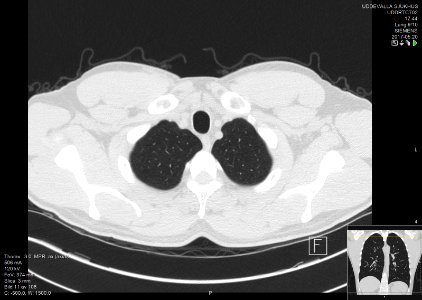 High-resolution computed tomograph of a normal thorax, axial plane (11)