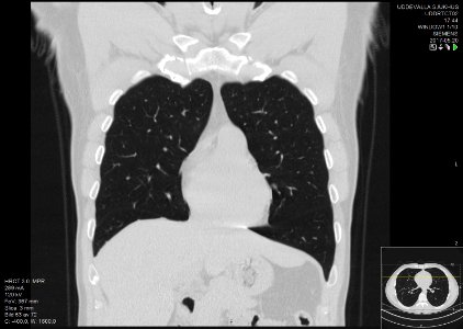 High-resolution computed tomograph of a normal thorax, coronal plane (17)