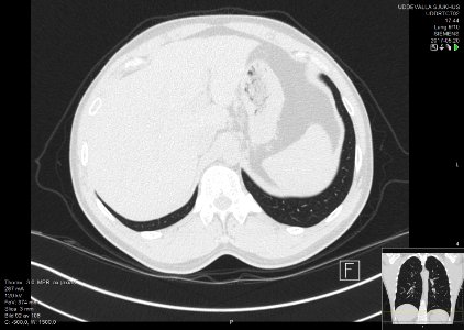 High-resolution computed tomograph of a normal thorax, axial plane (100)