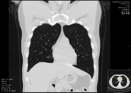 High-resolution computed tomograph of a normal thorax, coronal plane (15)