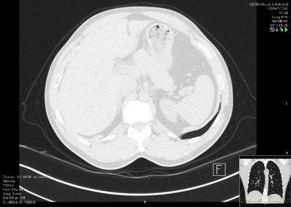 High-resolution computed tomograph of a normal thorax, axial plane (109)