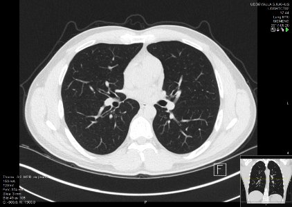 High-resolution computed tomograph of a normal thorax, axial plane (49)
